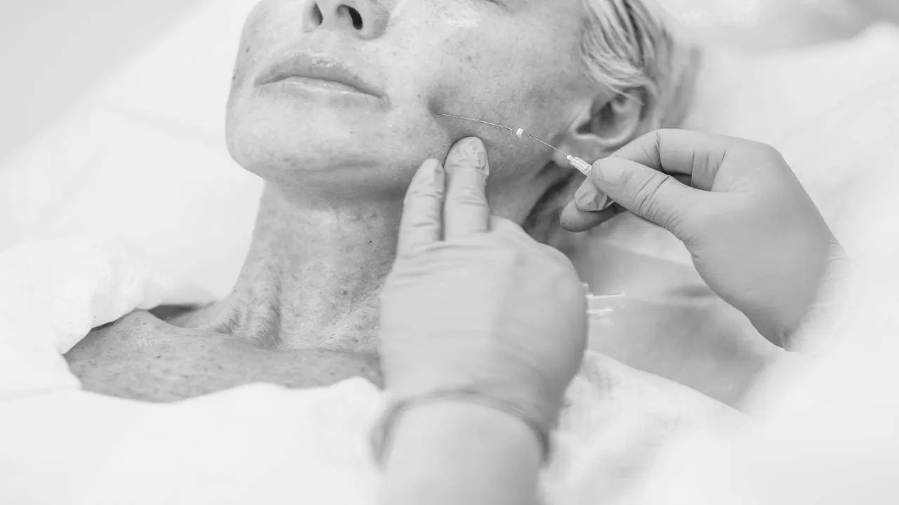 PDO Thread Lift: Lift your Jaw, Neckline, Brows, Mid Face & More