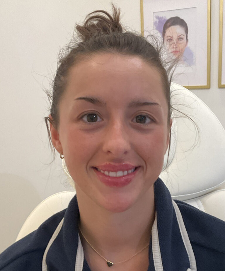 After Image: Lip Filler, Lip Flip - front