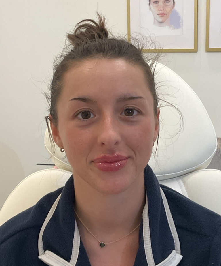After Image: Lip Filler, Lip Flip - front