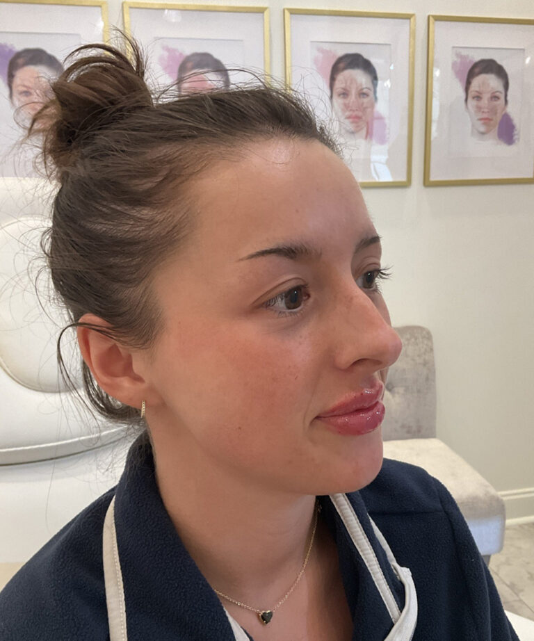 After Image: Lip Filler, Lip Flip - right-front-oblique