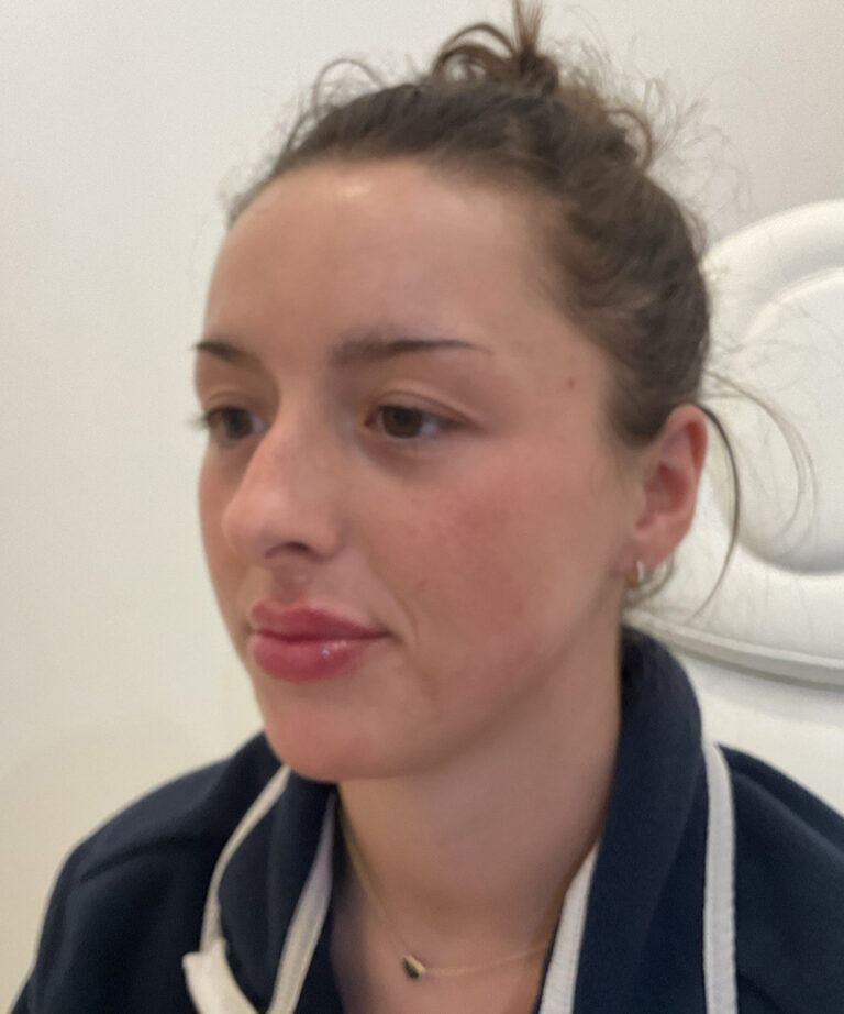 After Image: Lip Filler, Lip Flip - left-front-oblique