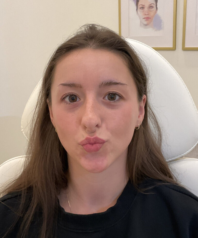 Before Image: Lip Filler, Lip Flip - front