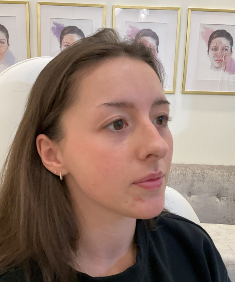 Before Image: Lip Filler, Lip Flip - right-front-oblique