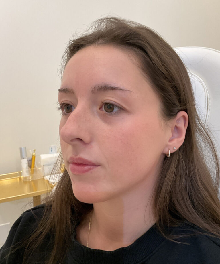 Before Image: Lip Filler, Lip Flip - left-front-oblique