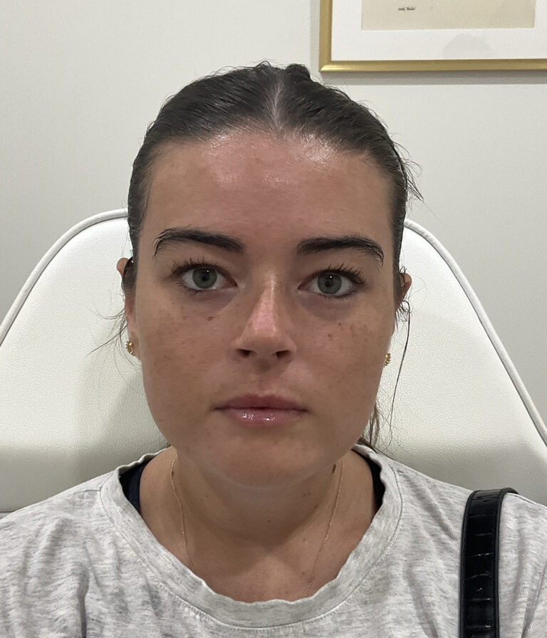 After Image: Lip Filler, Neurotoxin - front