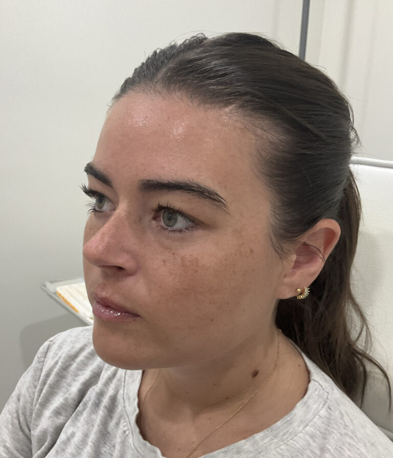 After Image: Lip Filler, Neurotoxin - left-front-oblique