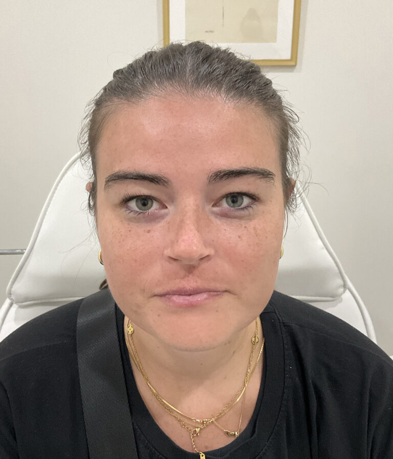 Before Image: Lip Filler, Neurotoxin - front