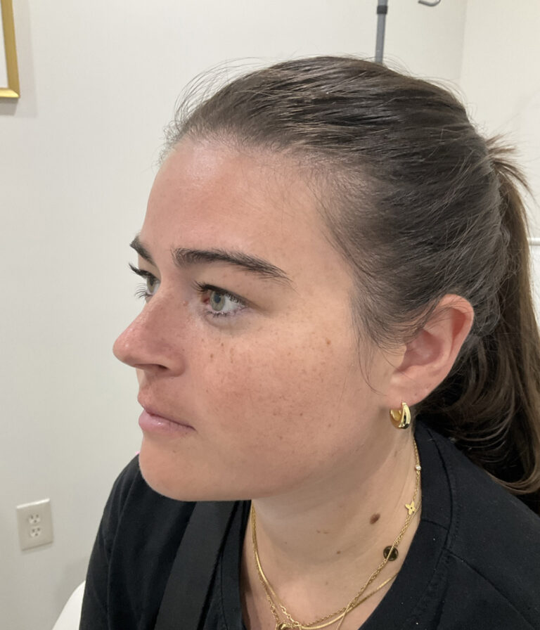 Before Image: Lip Filler, Neurotoxin - left-front-oblique