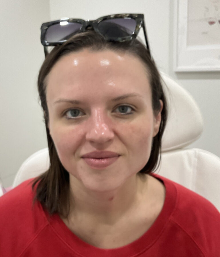 After Image: Neurotoxins, Chemical Peel, Dermal Filler - front