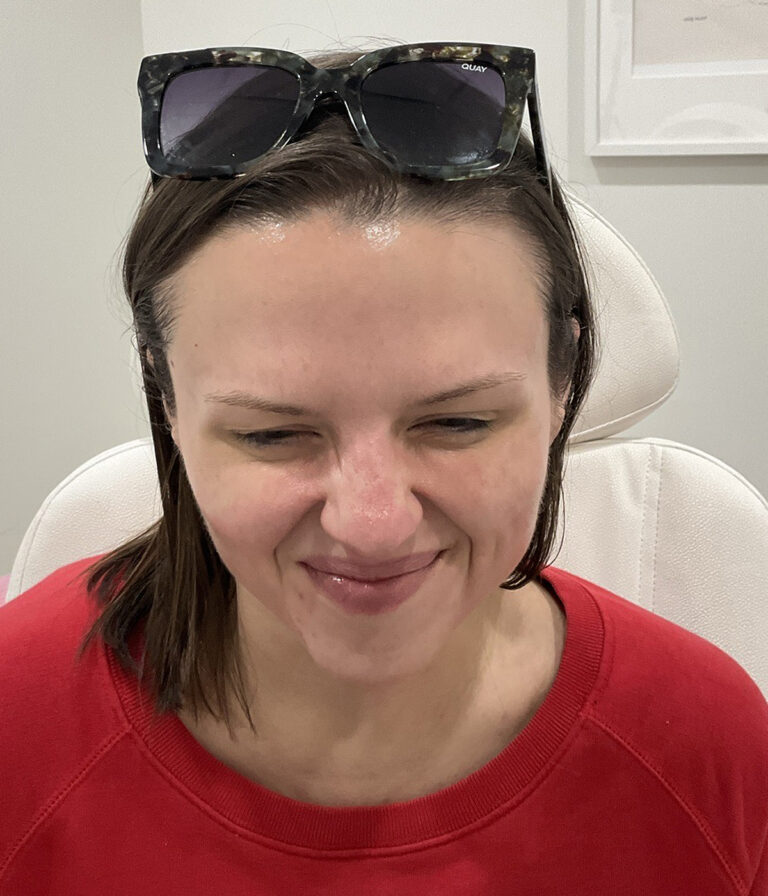 After Image: Neurotoxins, Chemical Peel, Dermal Filler - front