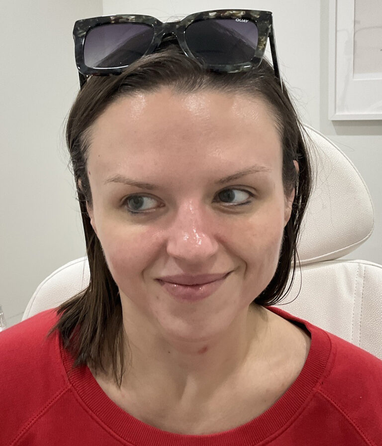 After Image: Neurotoxins, Chemical Peel, Dermal Filler - front