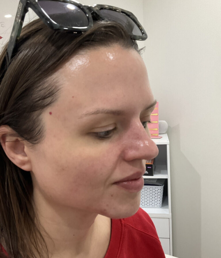 After Image: Neurotoxins, Chemical Peel, Dermal Filler - right-front-oblique