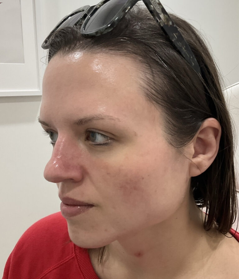 After Image: Neurotoxins, Chemical Peel, Dermal Filler - left-front-oblique