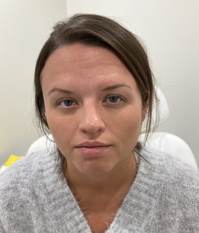 Before Image: Neurotoxins, Chemical Peel, Dermal Filler - front