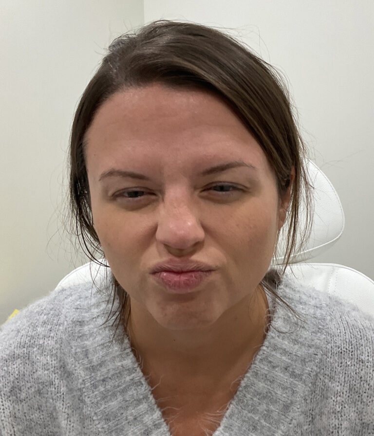 Before Image: Neurotoxins, Chemical Peel, Dermal Filler - front