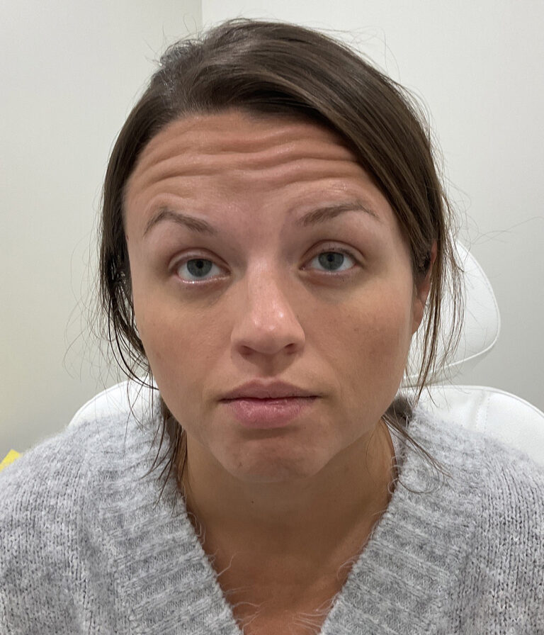 Before Image: Neurotoxins, Chemical Peel, Dermal Filler - front