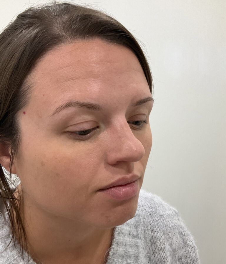 Before Image: Neurotoxins, Chemical Peel, Dermal Filler - right-front-oblique