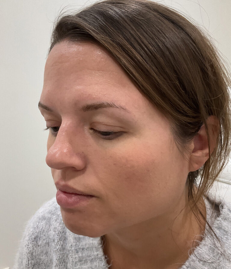 Before Image: Neurotoxins, Chemical Peel, Dermal Filler - left-front-oblique