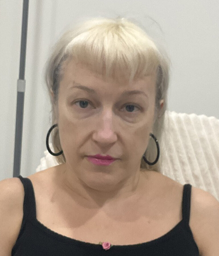 After Image: PRF, Dermal Filler - front