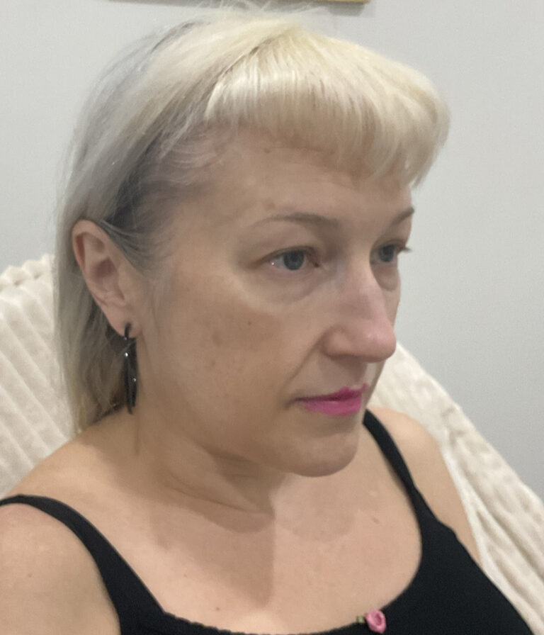 After Image: PRF, Dermal Filler - right-front-oblique