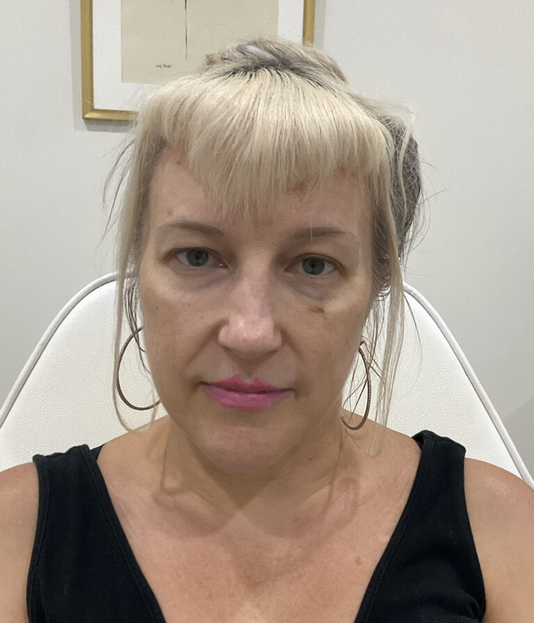 Before Image: PRF, Dermal Filler - front