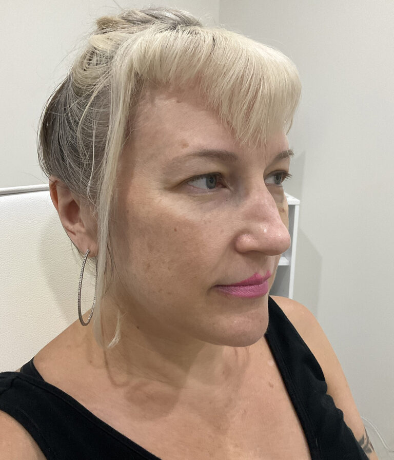 Before Image: PRF, Dermal Filler - right-front-oblique